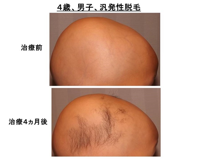 円形脱毛症　病院""